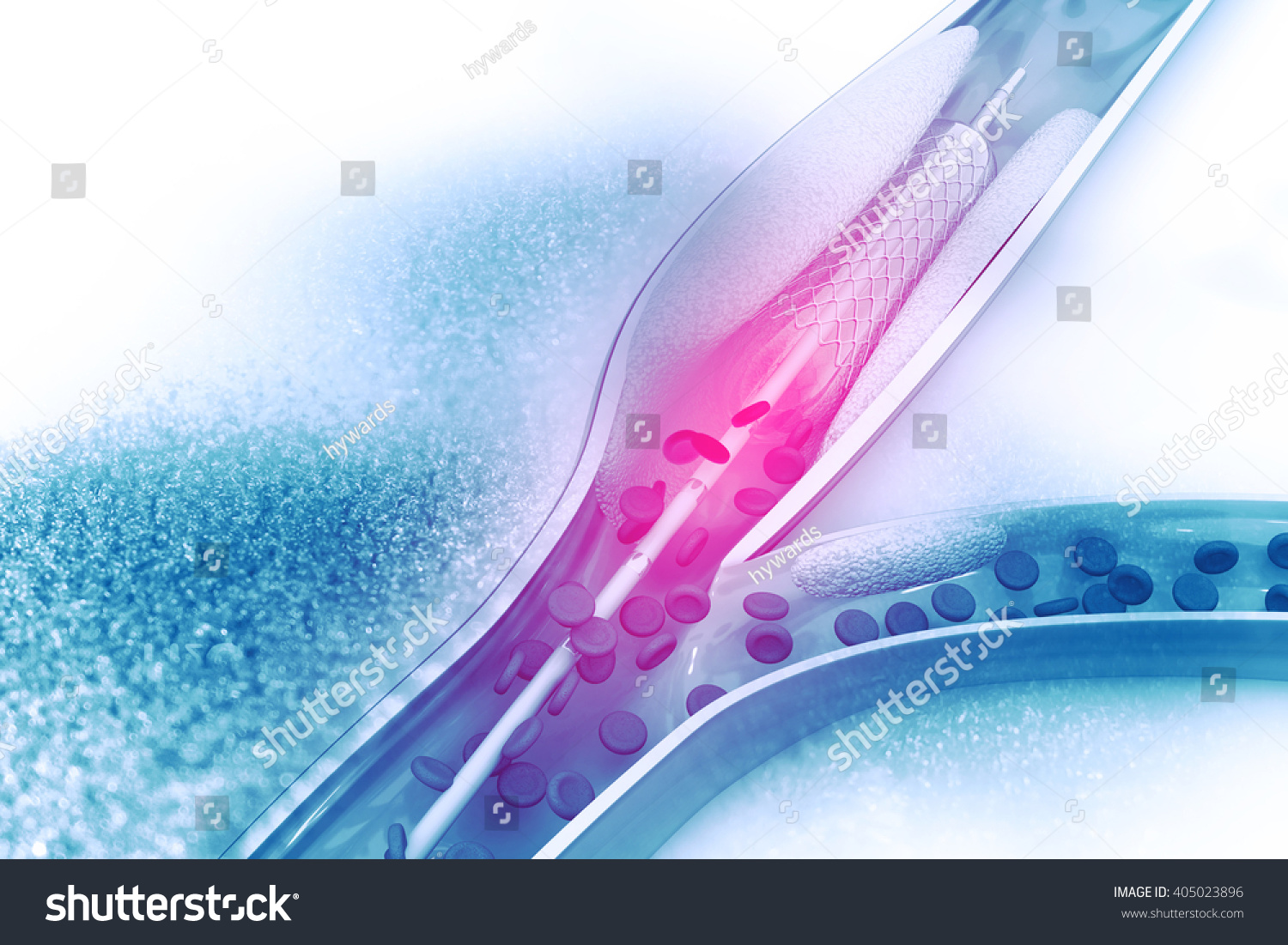 Stent Angioplasty Procedure Placing Balloon Stock Illustration ...