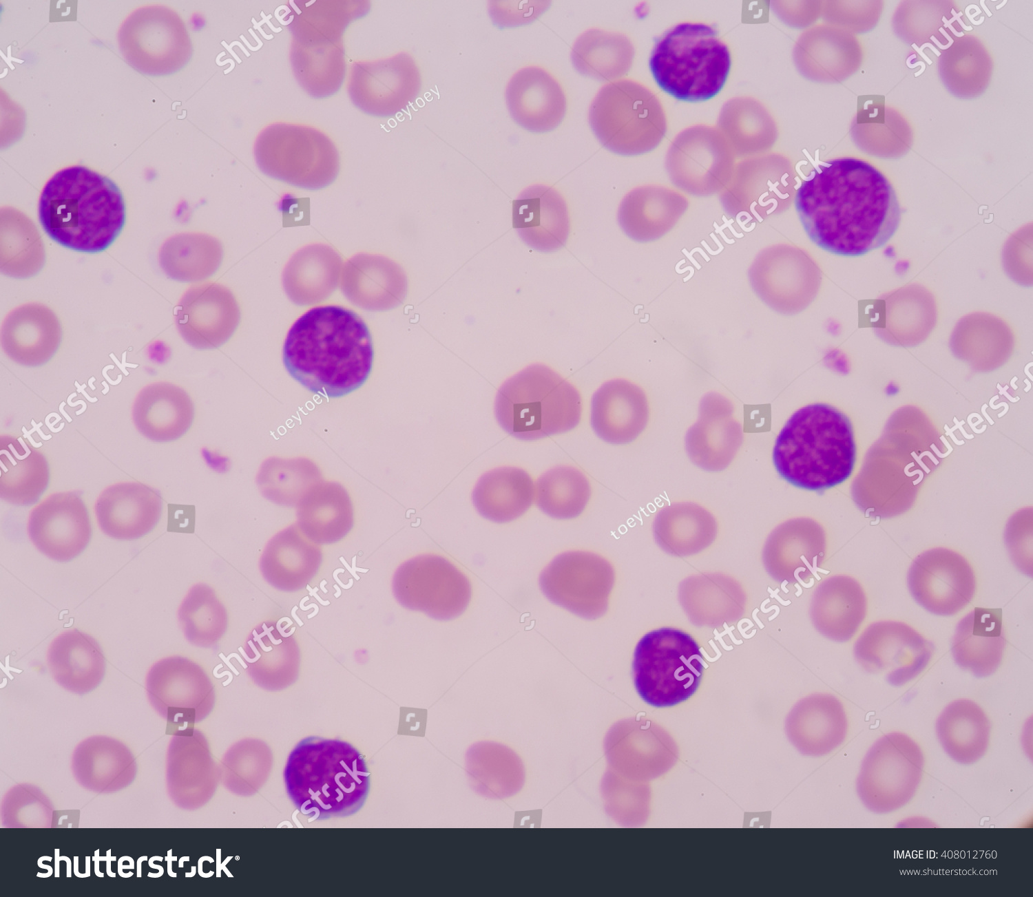 Acute Myelogenous Leukemia Amlmost Aml Subtypes Stock Photo 408012760 ...