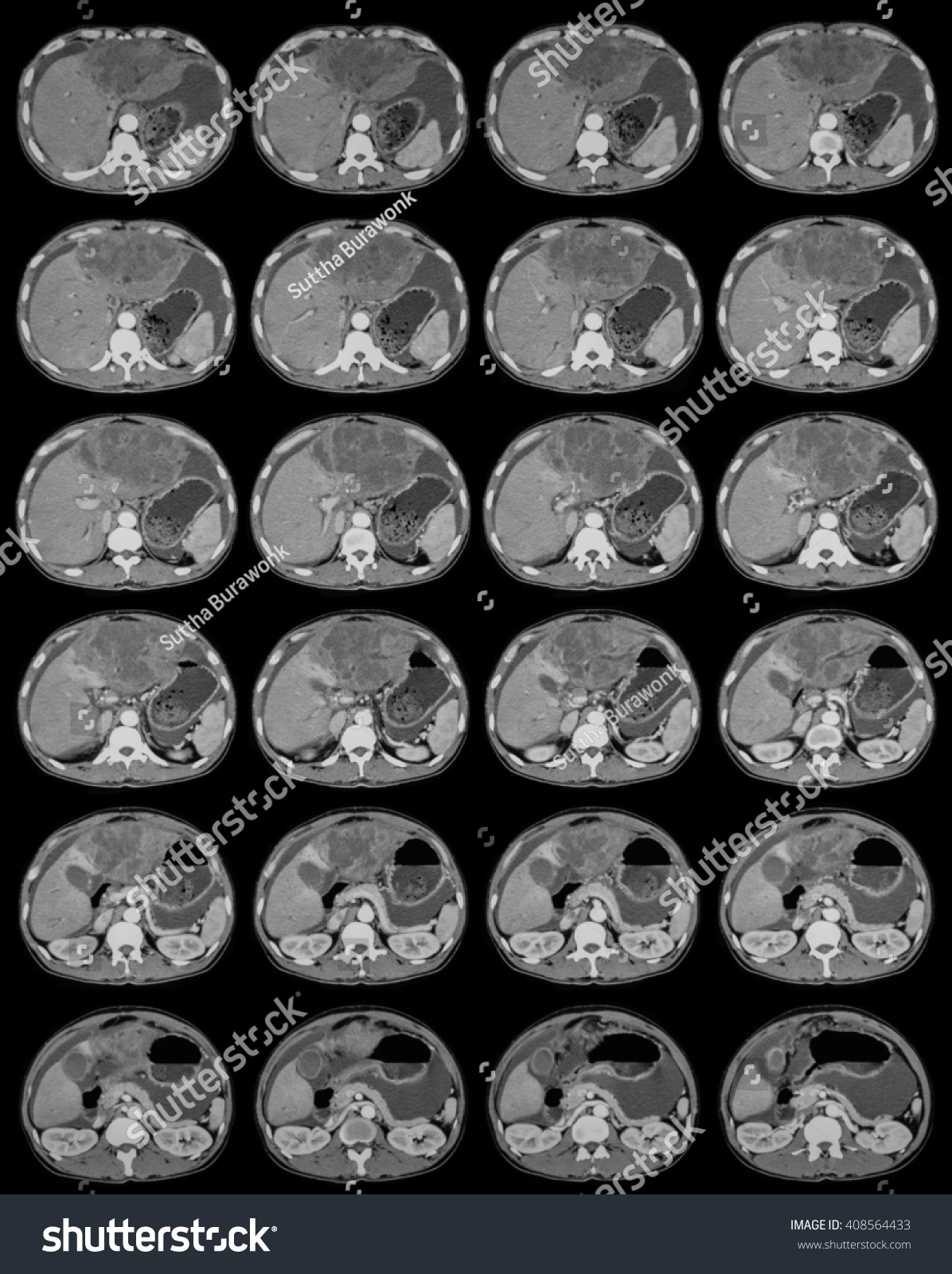 Ct Scan Abdomen Case Liver Mass Stock Photo 408564433 | Shutterstock