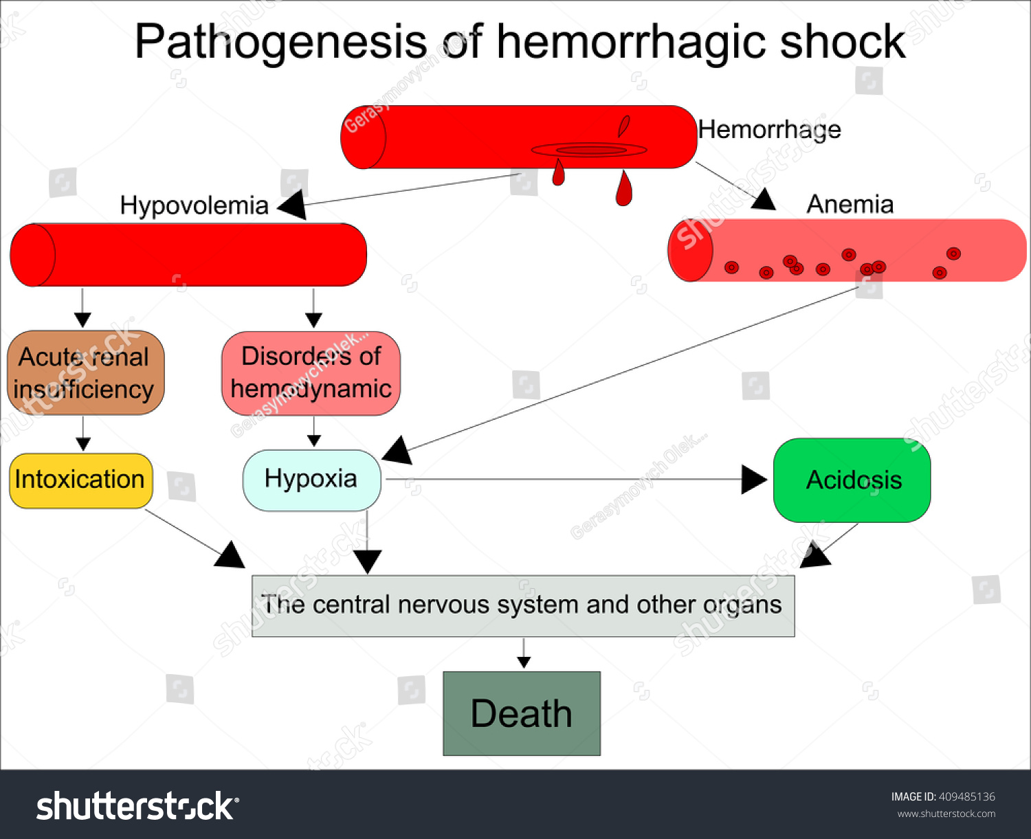 hypovolemic shock chart