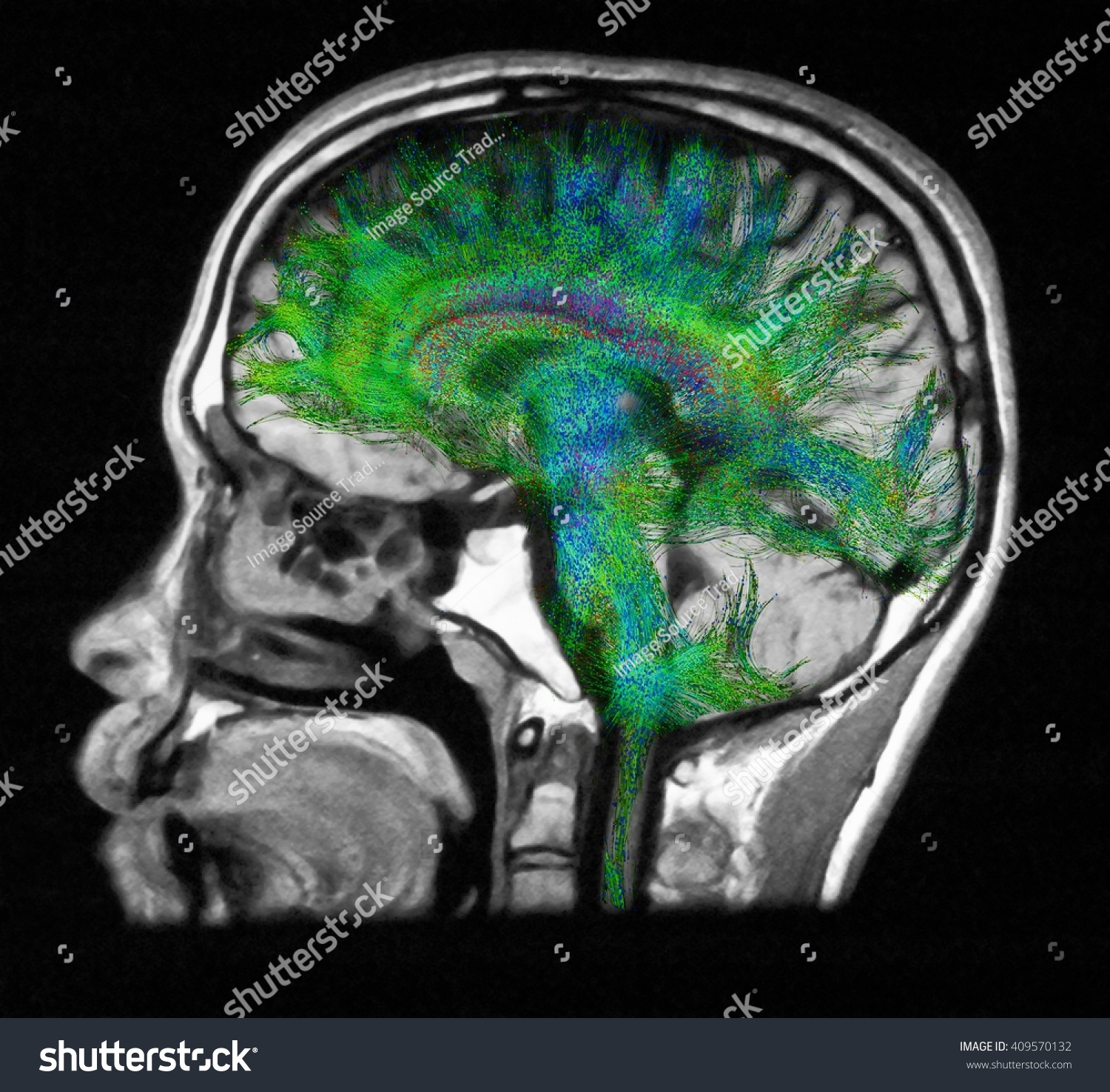 Diffusion Mri Referred Diffusion Tensor Imaging Stock Photo 409570132 ...