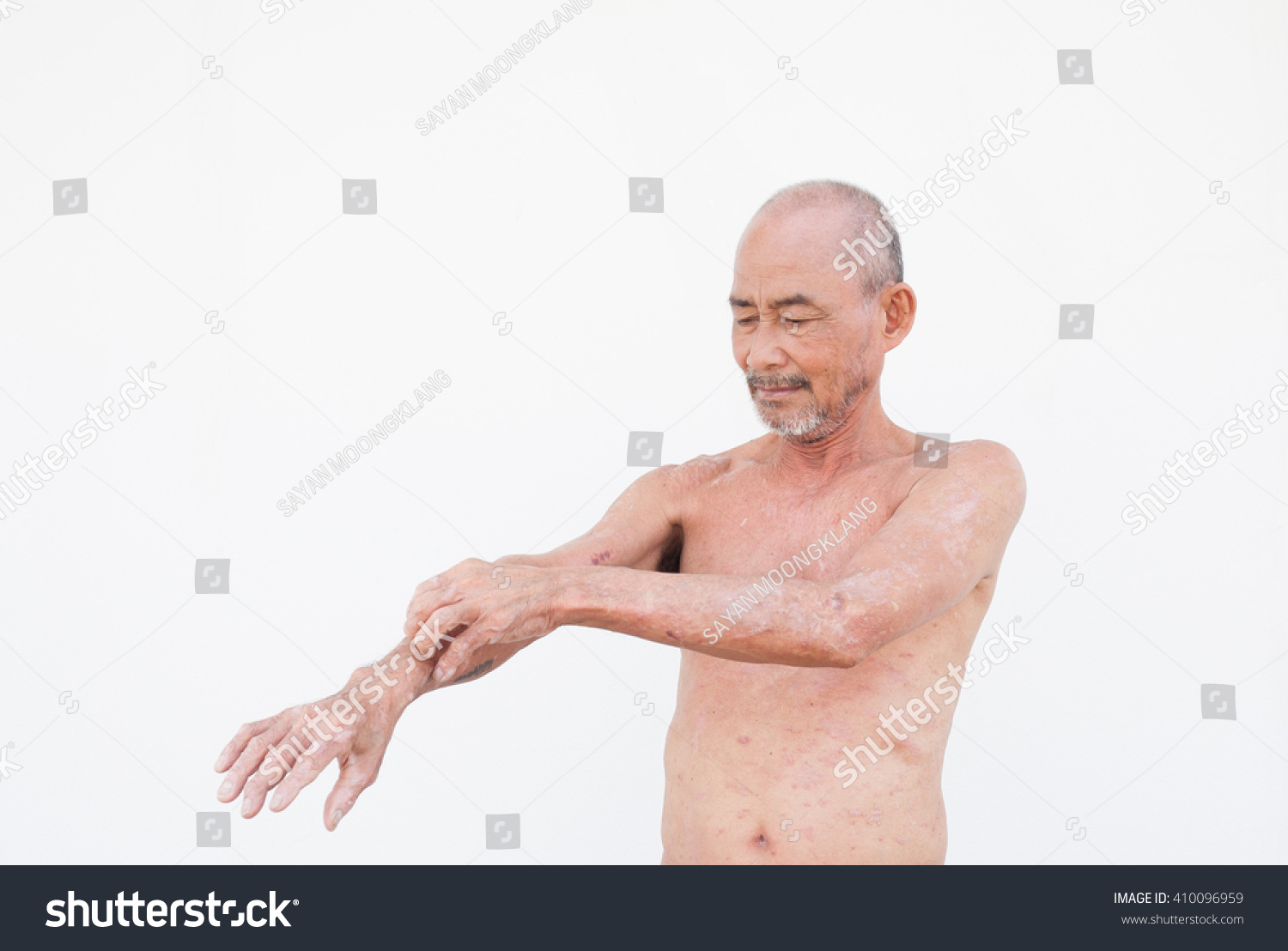 63yearsold Man Who Skin Disease On Stock Photo 410096959 Shutterstock 63yearsold-man-who-skin-disease-on-stock-photo-410096959-shutterstock