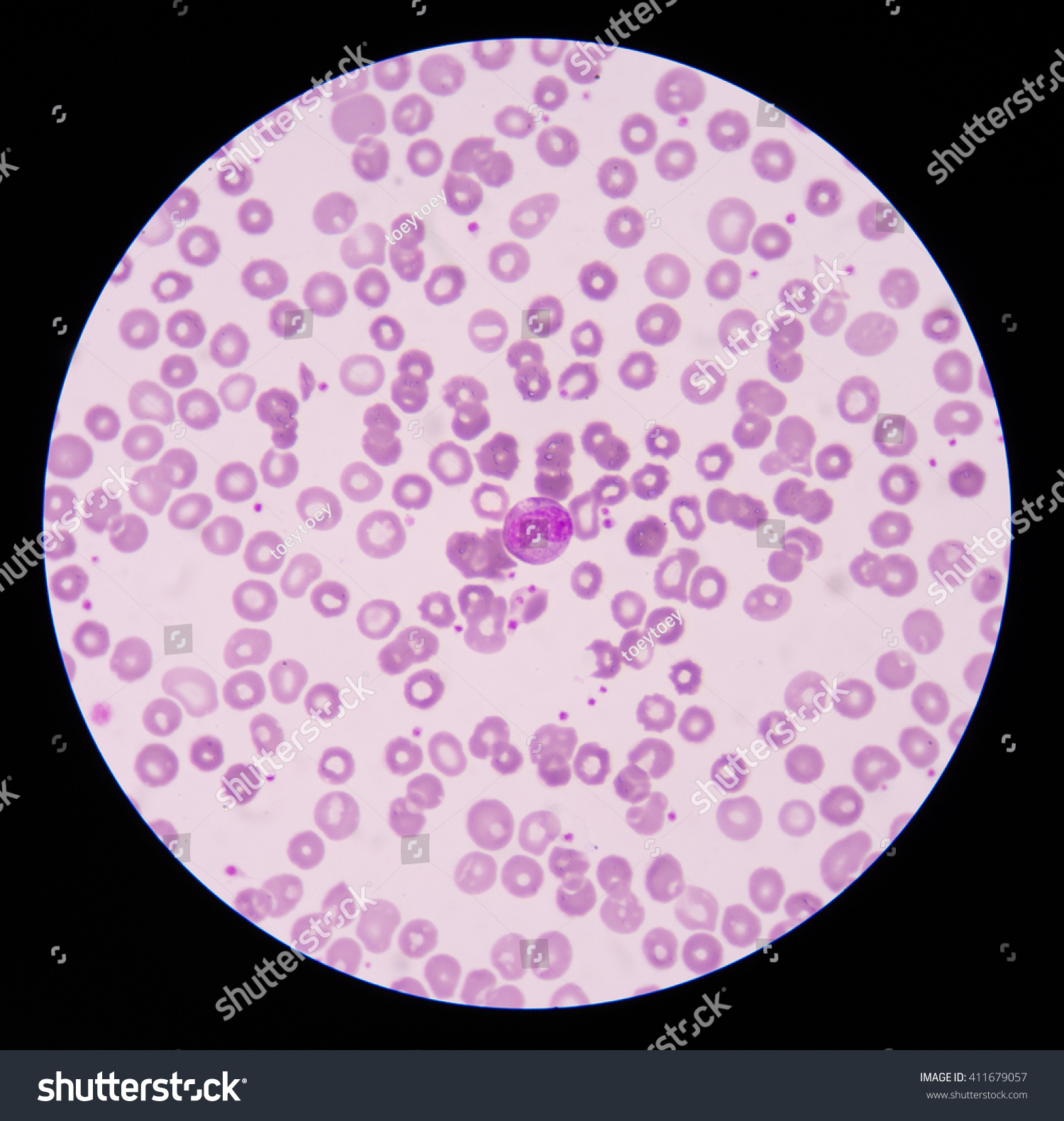 Neutrophilic Metamyelocyte On Center Red Blood Stock Photo 411679057 ...