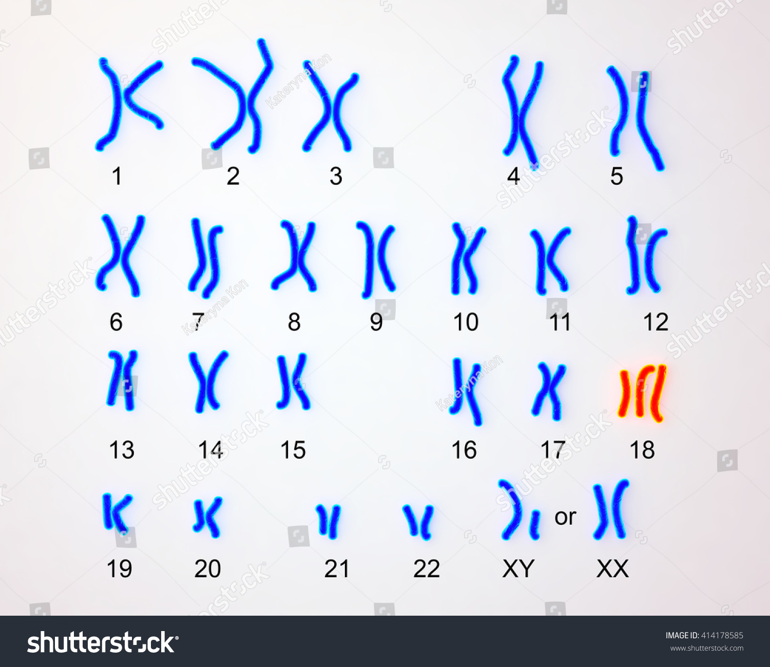 Edwardssyndrome Karyotype Labeled Trisomy 18 3d 스톡 일러스트 414178585 ...