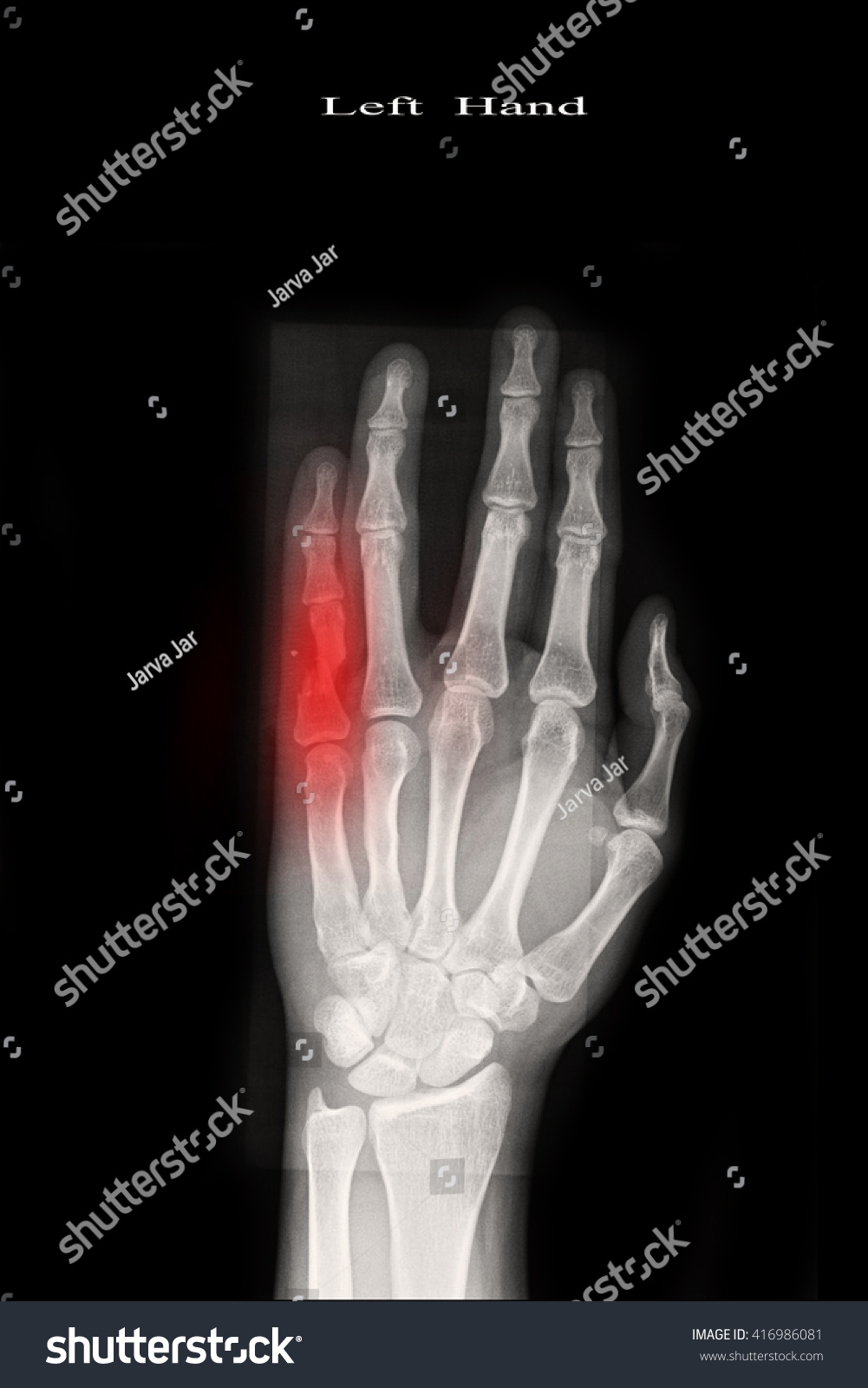 Xray Both Hand Fracture Little Finger Stock Photo 416986081 | Shutterstock