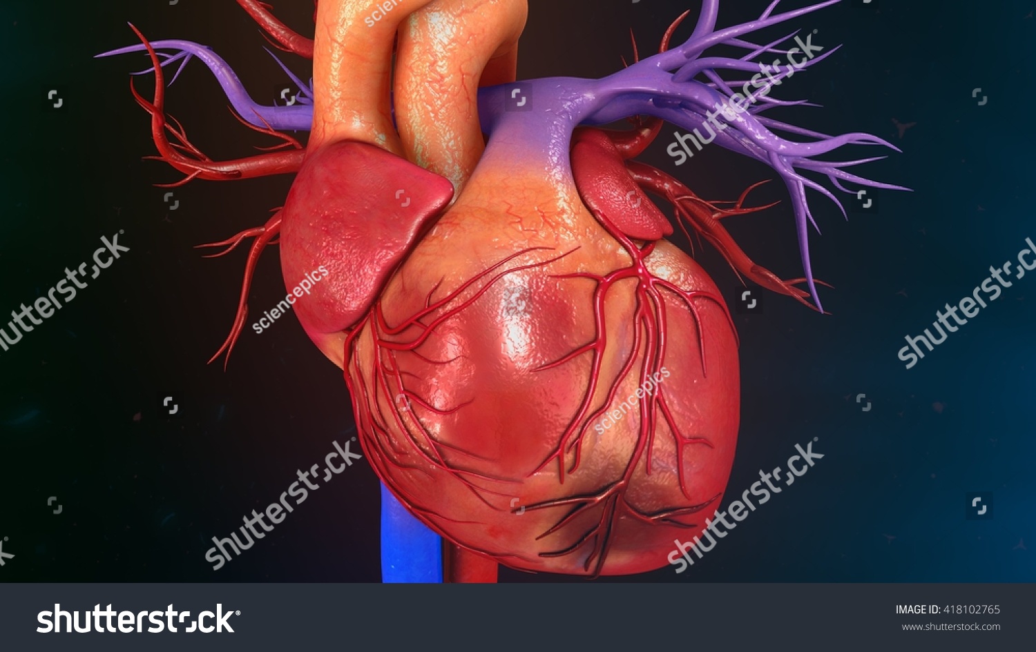 Myocardial Infarction 3d Illustration Stock Illustration 418102765