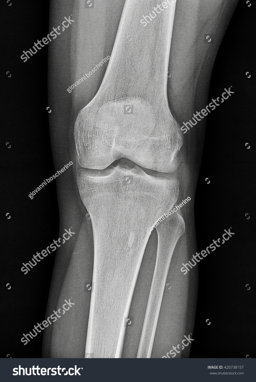 Xrays Knees Anterior Posterior Projection Stock Photo 420738157 ...