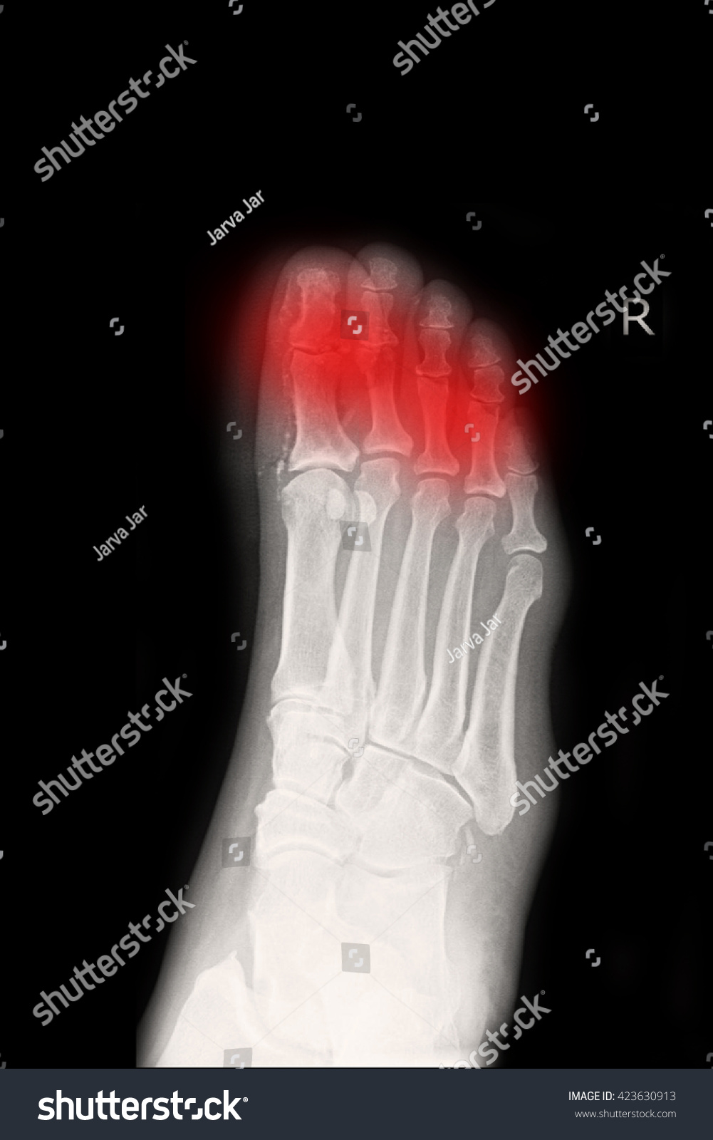 Xray Right Foot Fracture Right Foot Stock Photo 423630913 | Shutterstock