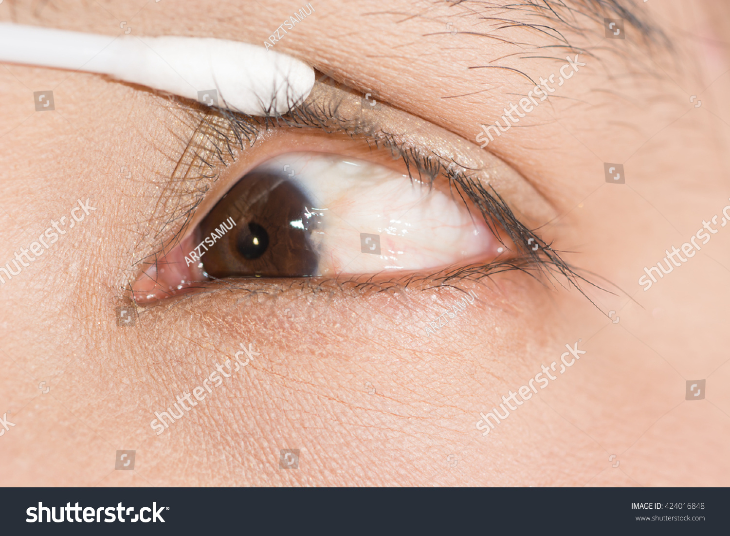 Close Advance Pterygium During Eye Examination Stock Photo 424016848 ...