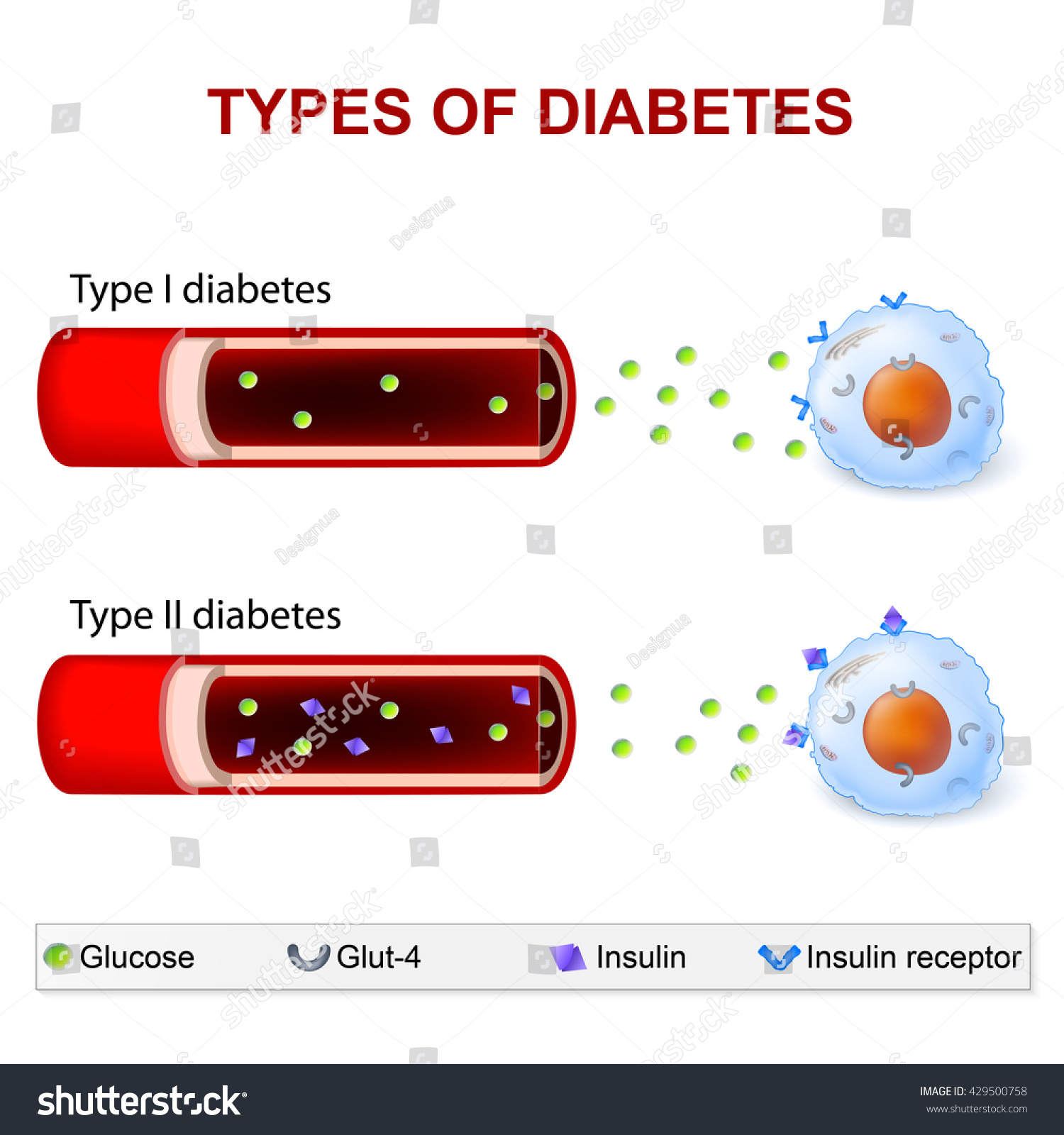 Ilustrasi Stok Types Diabetes Mellitus Insulindependent Diabetes