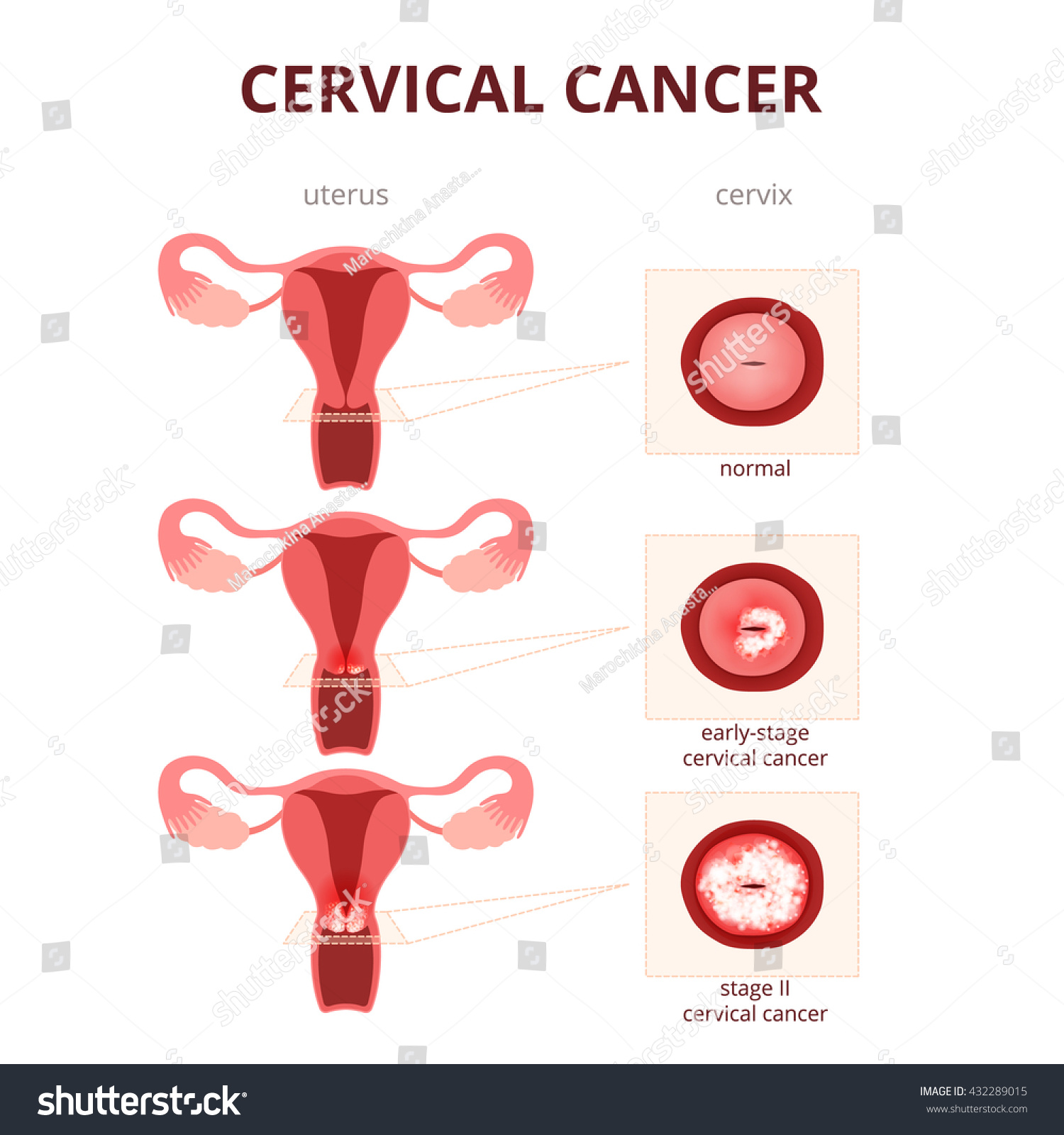 Cervical Cancer Schematic Illustration Uterus Cervix Arkivvektor