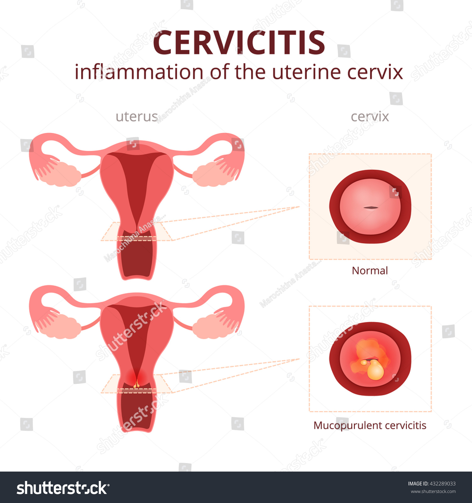 Cervicitis Schematic Illustration Uterus Cervix Female: Vector στοκ (χωρίς ...