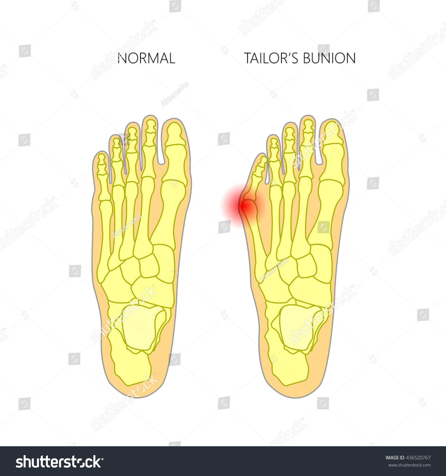 Colored Illustration Tailors Bunion Used Gradient Stock Vector (Royalty ...