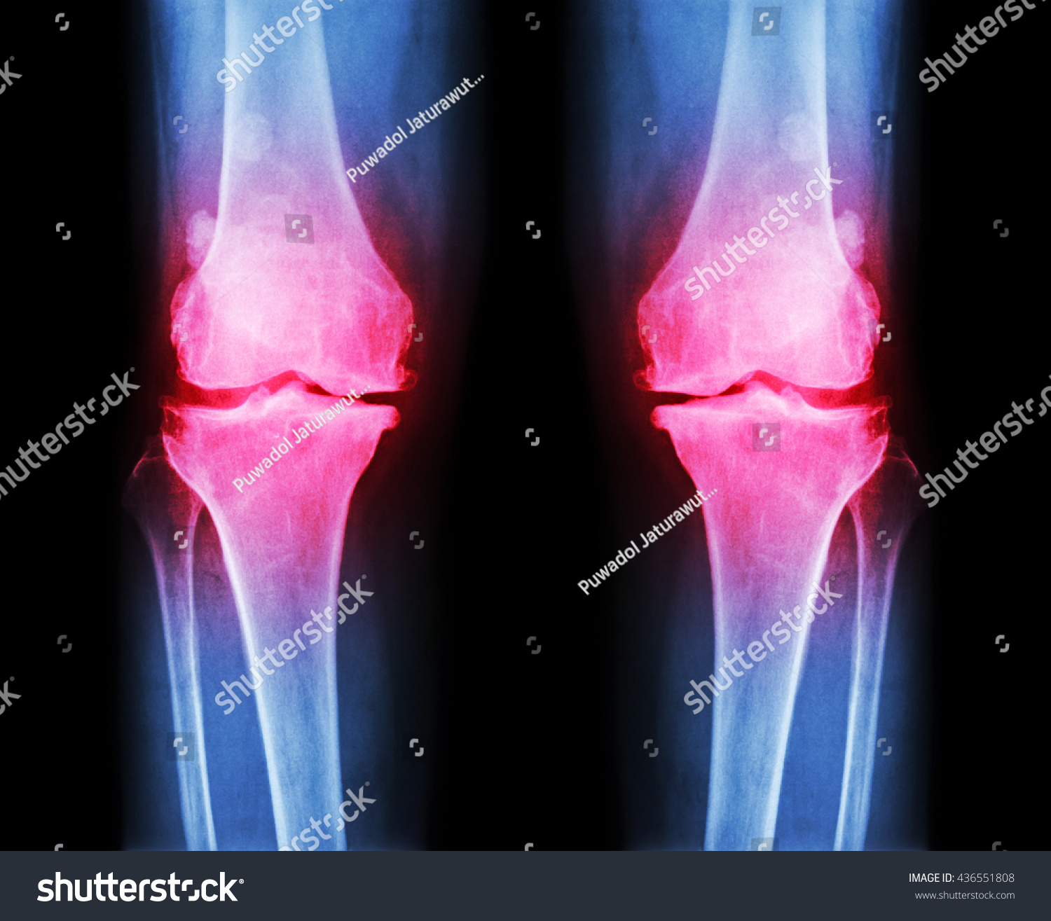 Osteoarthritis Both Knee Film Xray Ap Stock Photo 436551808 | Shutterstock