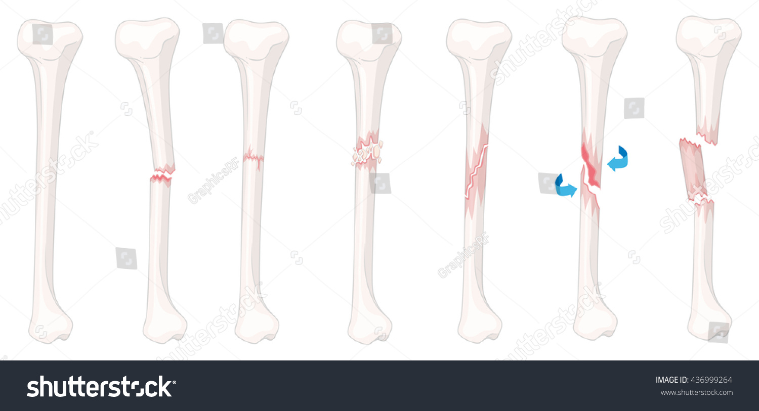 Different Stages Leg Fracture Illustration Stock Vector (Royalty Free ...