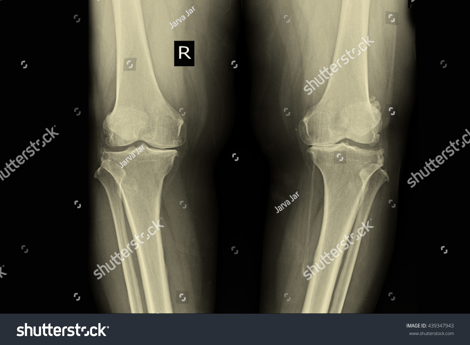 Oa Both Knee Osteoporosis Stock Photo 439347943 | Shutterstock