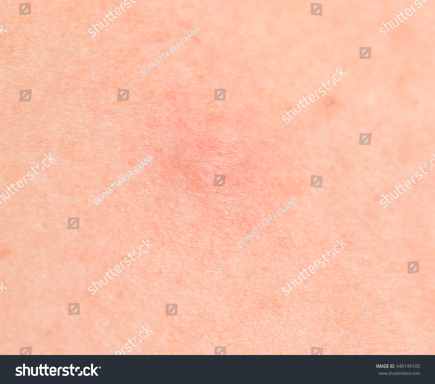 Red Spots On Skin Sun Stock Photo 440149105 | Shutterstock