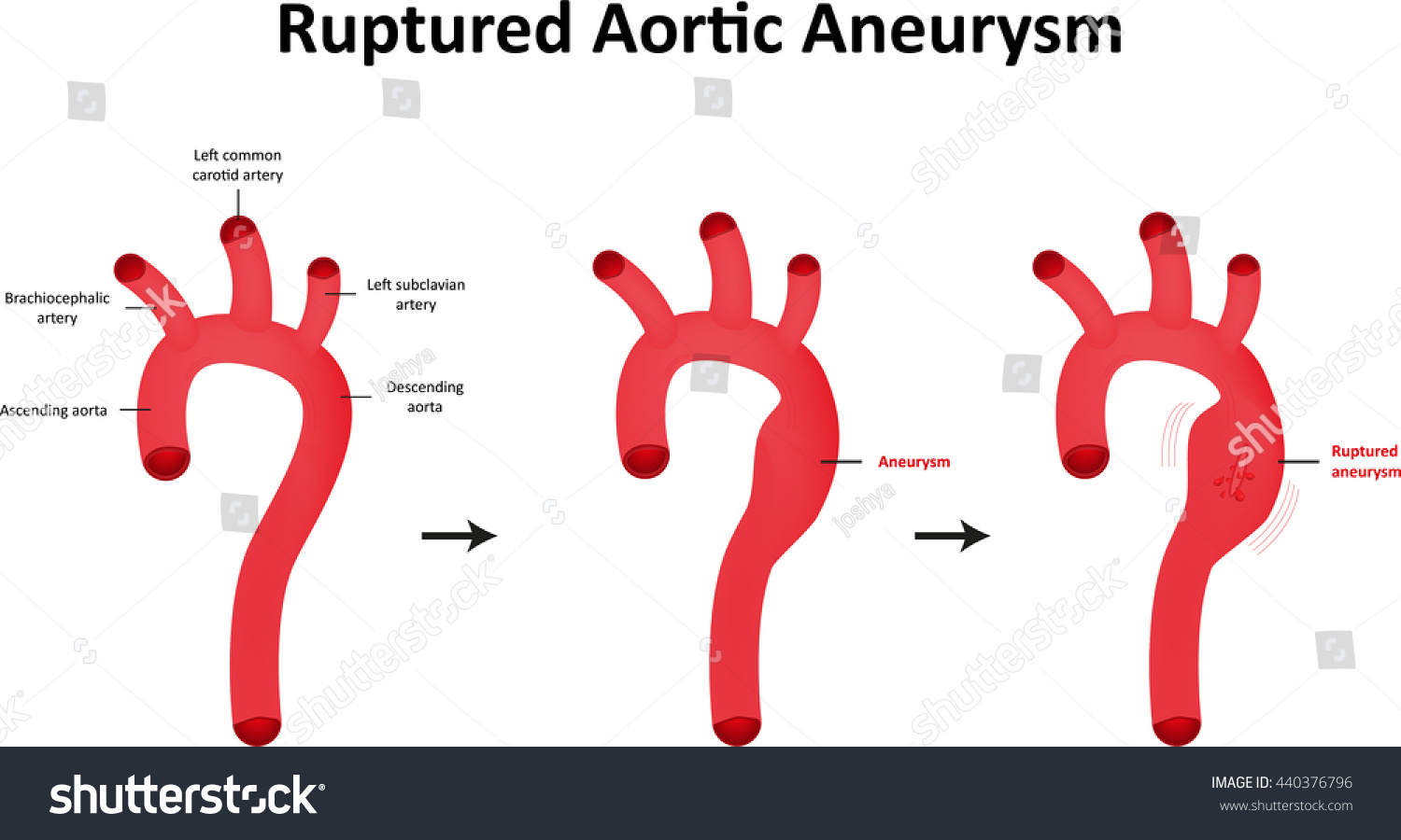 Vektor Stok Ruptured Aortic Aneurysm Labeled Diagram Tanpa Royalti 440376796 Shutterstock 6041