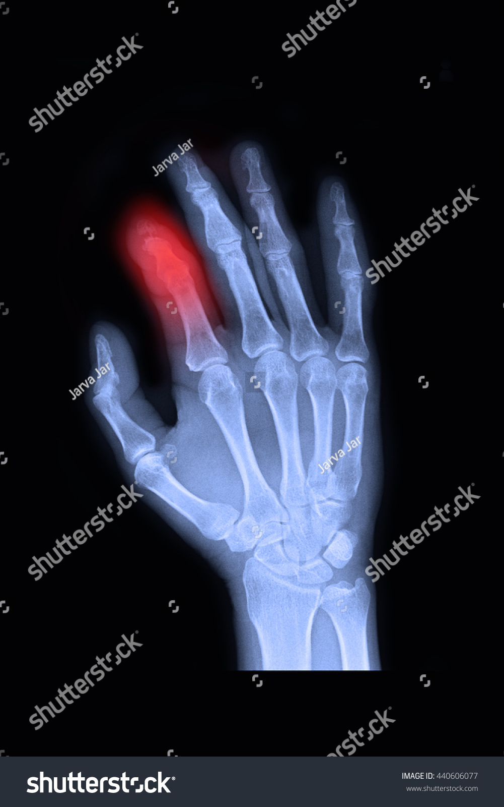 Xray Right Hand Show Fracture Index Stock Photo 440606077 | Shutterstock