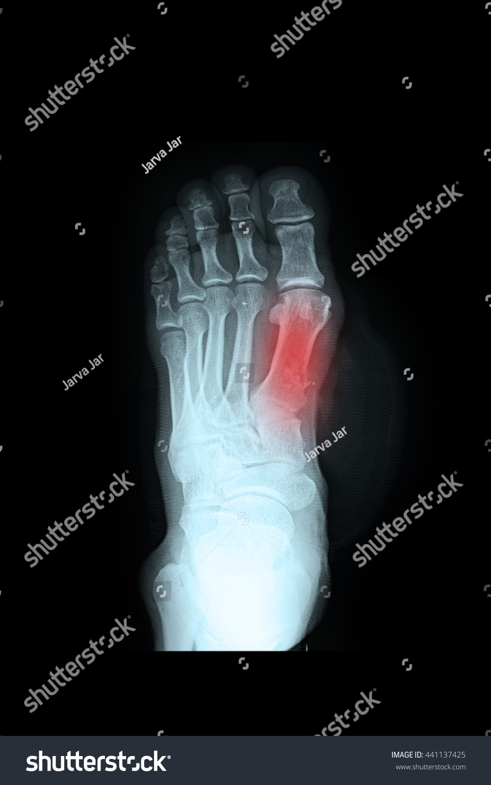 Xray Left Foot Fracture Big Toe Stock Photo 441137425 | Shutterstock