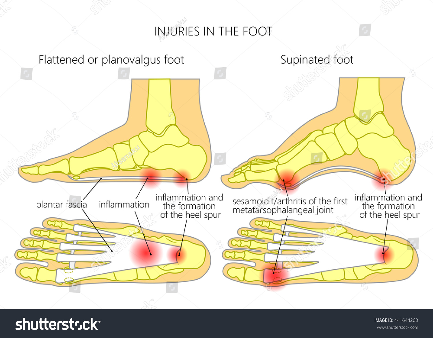 Injuries Foot Plantar Fasciitis Heel Spur Stock Vector (Royalty Free ...