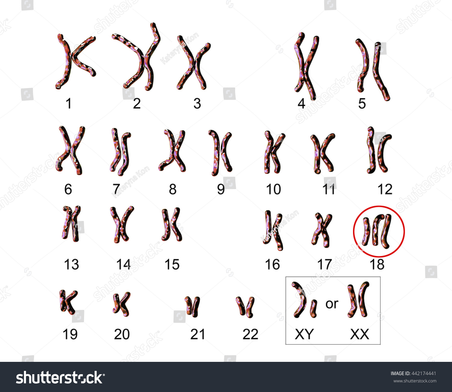 Ilustrasi Stok Edwardssyndrome Karyotype Labeled Trisomy 18 3d