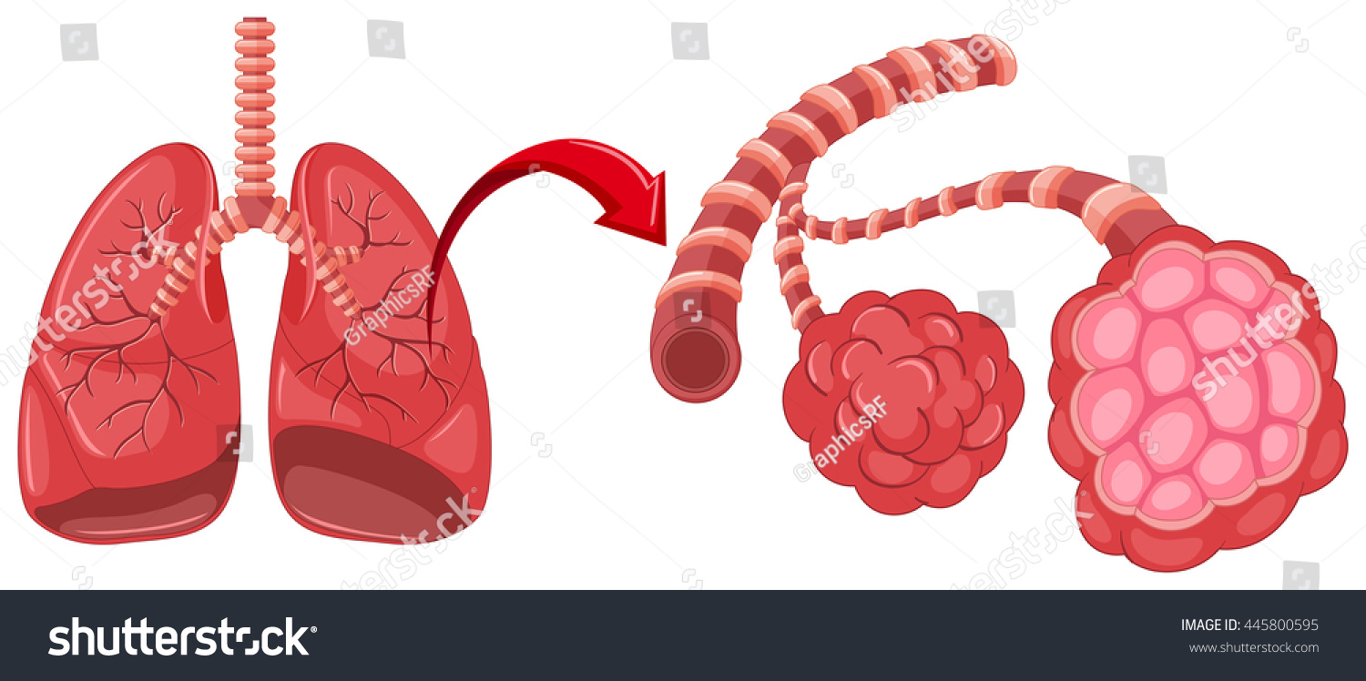 Pneumonia Diagram Zoom Lungs Illustration Stock Vector (Royalty Free ...