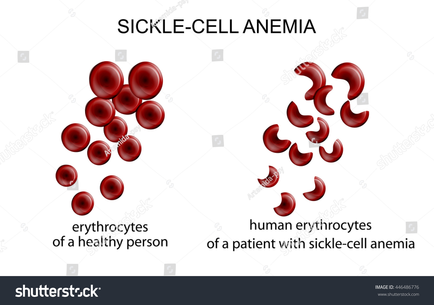 illustration-blood-cells-disease-sicklecell-anemia-stock-vector