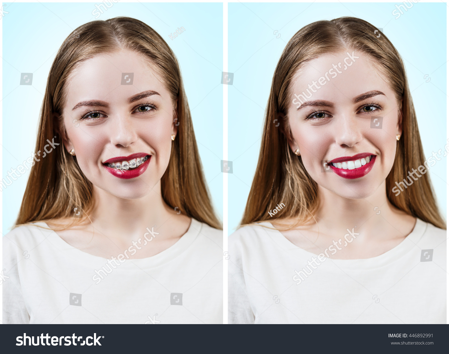 Овал лица после брекетов фото до и после