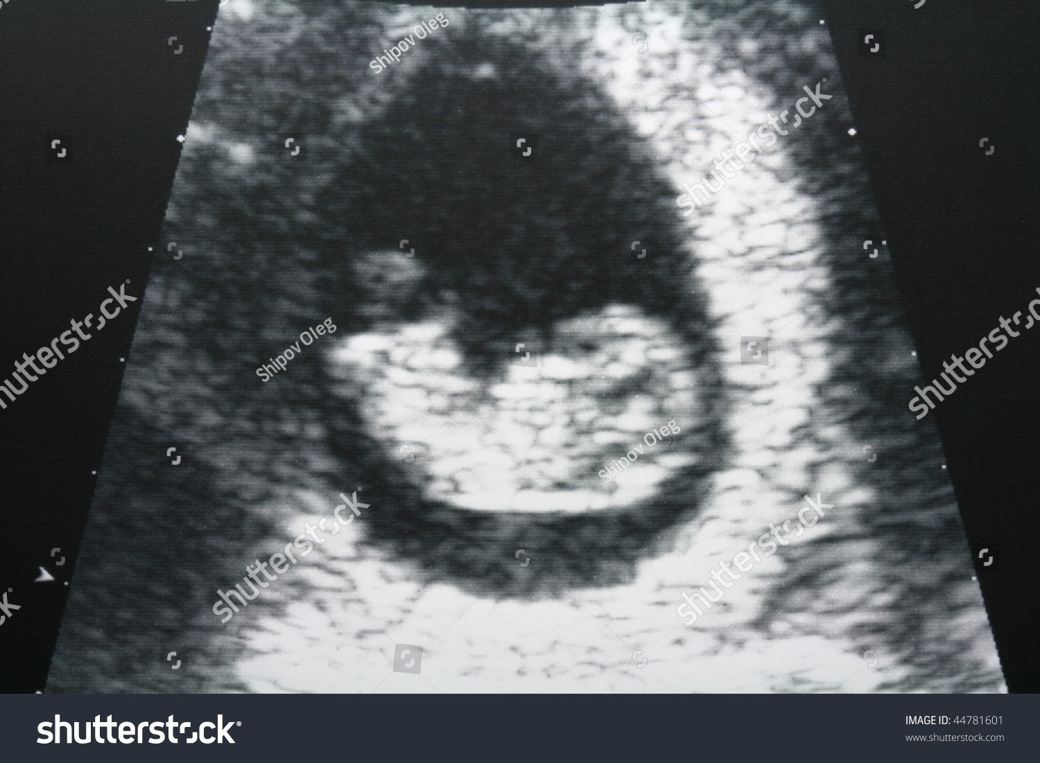 Эмбрион на 10 неделе беременности УЗИ