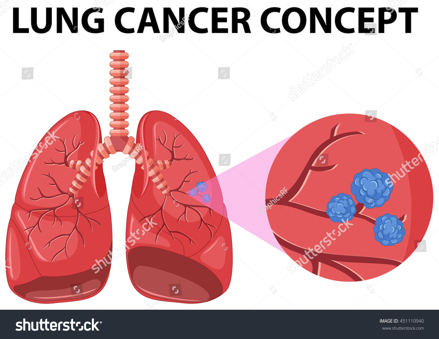 Diagram Lung Cancer Concept Illustration Stock Vector (Royalty Free ...