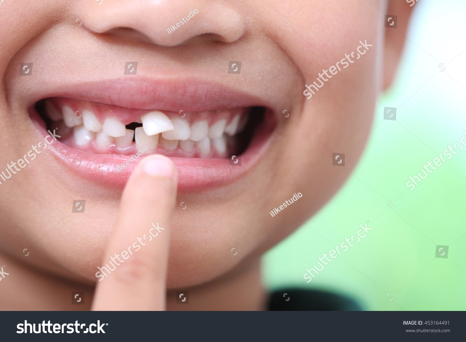 гнилые зубы у детей фото