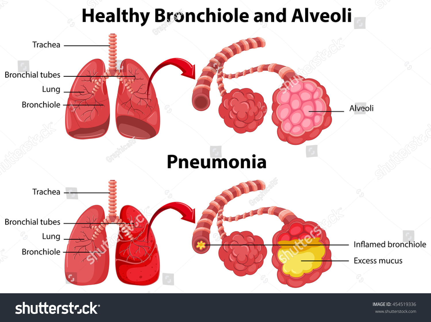 Healthy Unhealthy Human Lungs Illustration Stock Vector (Royalty Free ...