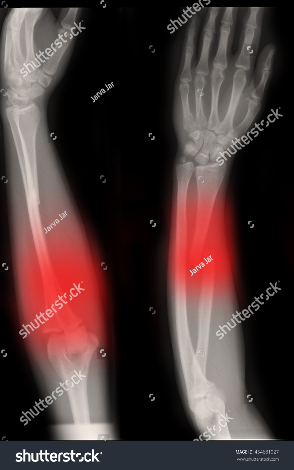 Fracture Shaft Radius Ulnar Bone Right Stock Photo 454681927 | Shutterstock