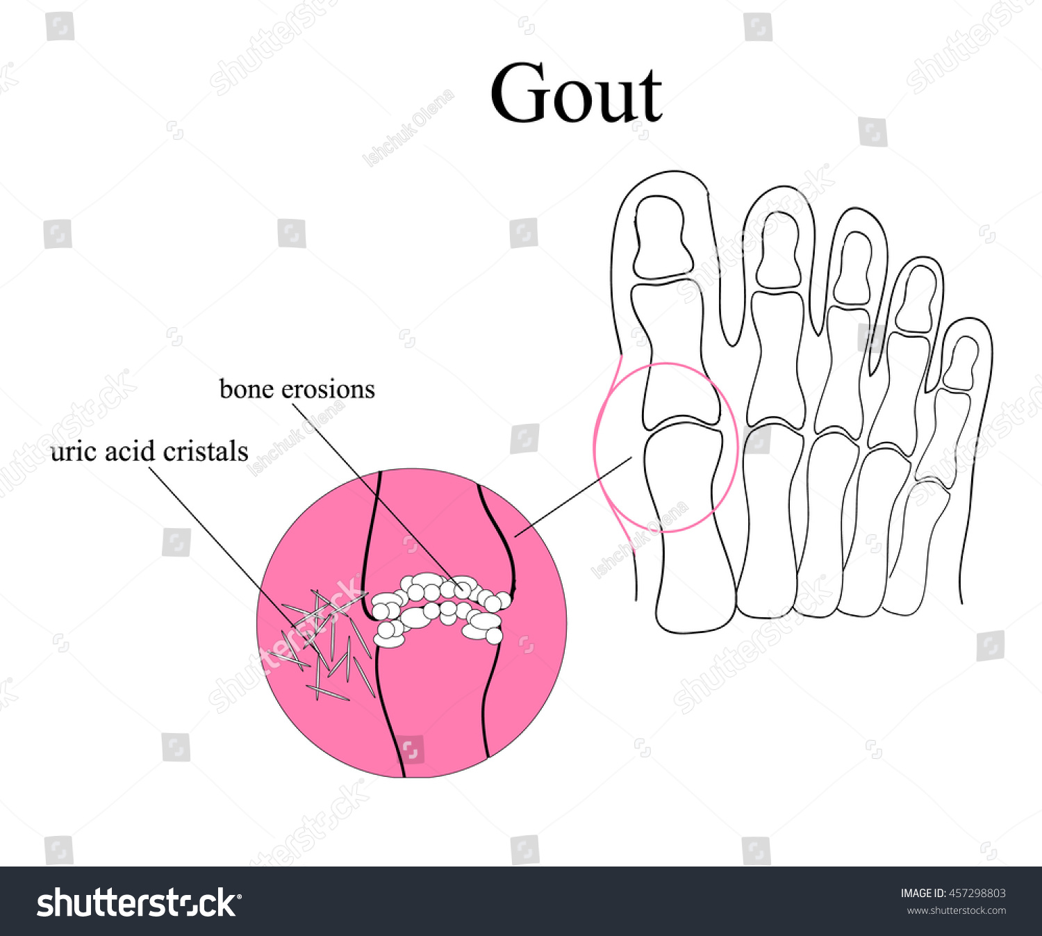 Diagram Gout Human Toe Illustration Stock Vector (Royalty Free ...