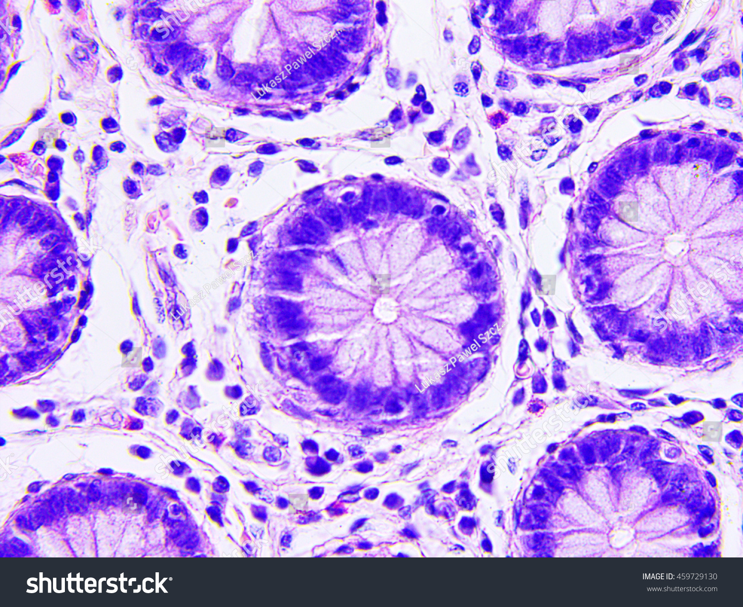 Colon Cancer Microscopic Photograph Stock Photo 459729130 | Shutterstock