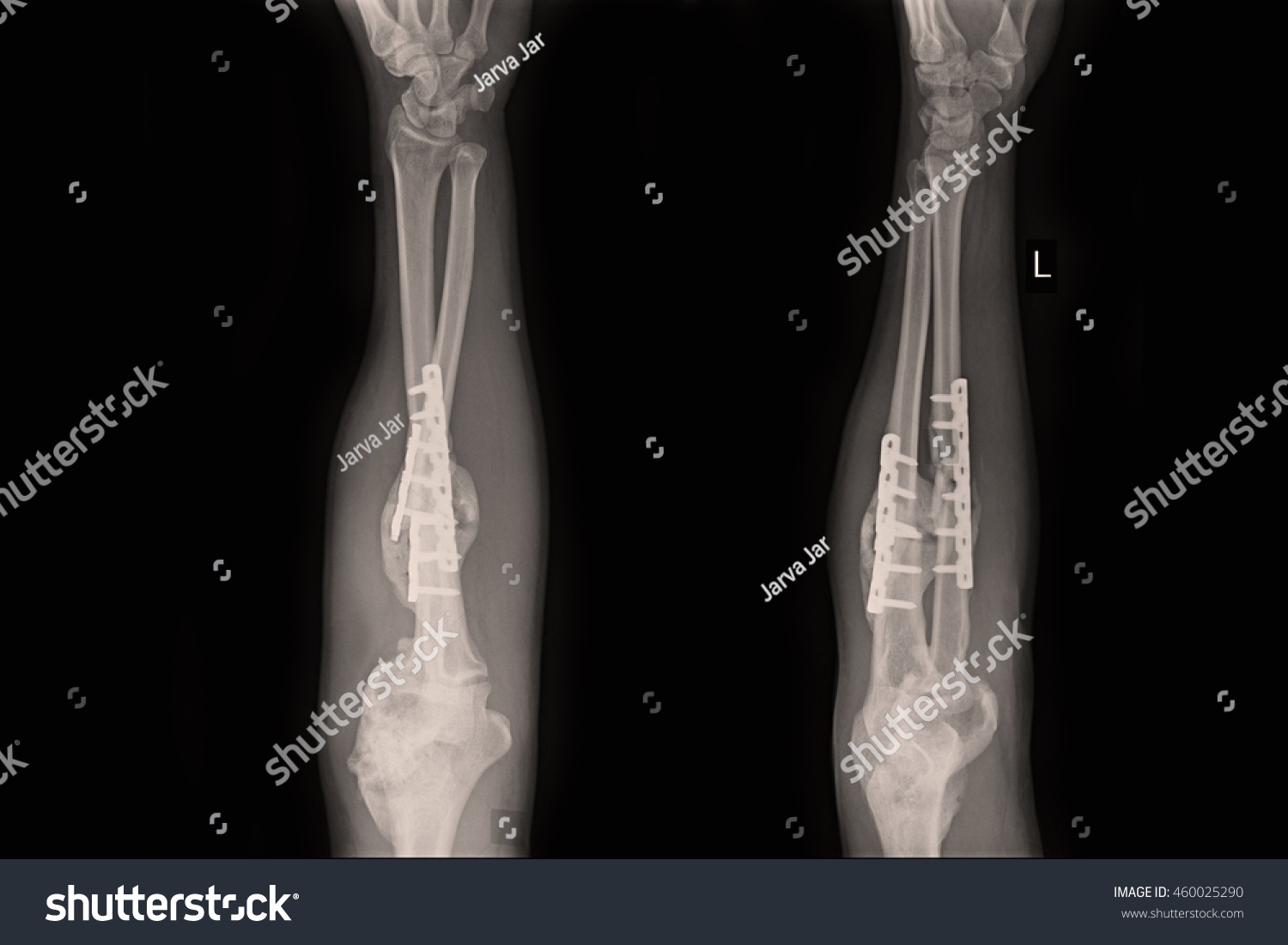 Xray Left Hand Show Fracture Shaft Stock Photo 460025296 | Shutterstock