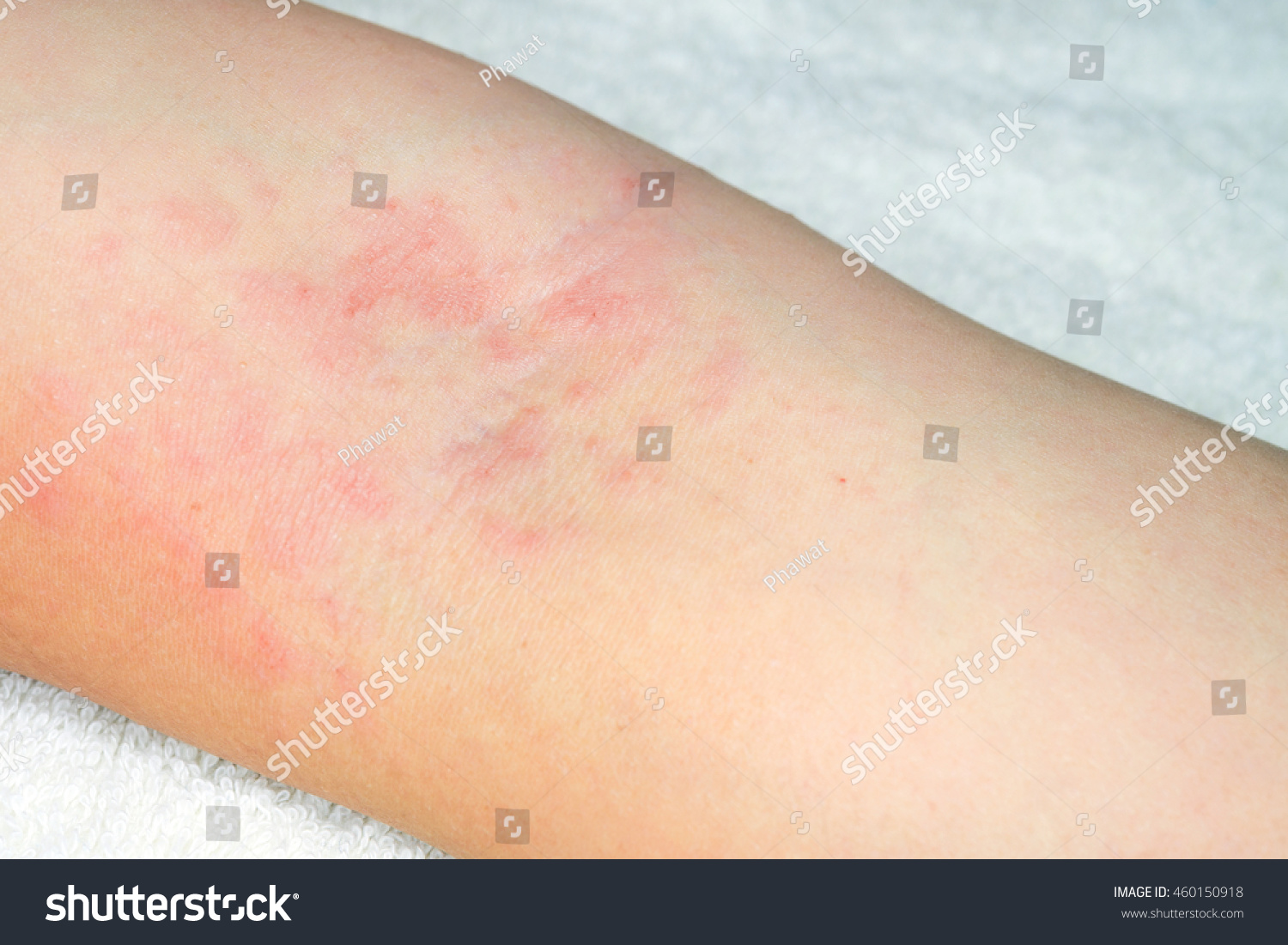 Allergy Red Rash On Arms On Foto Stok 460150918 Shutterstock 4414