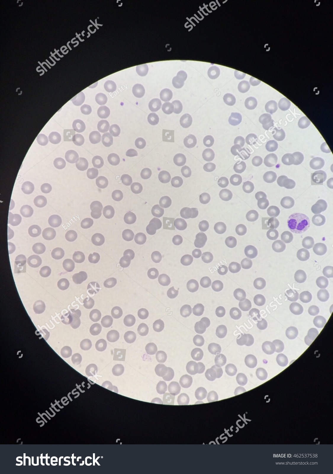 Peripheral Blood Smear Normal Human Blood Stock Photo 462537538 ...