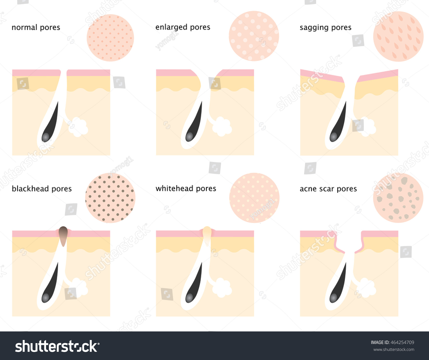 Diagram Skin Pores Normal Sagging Open Stock Vector