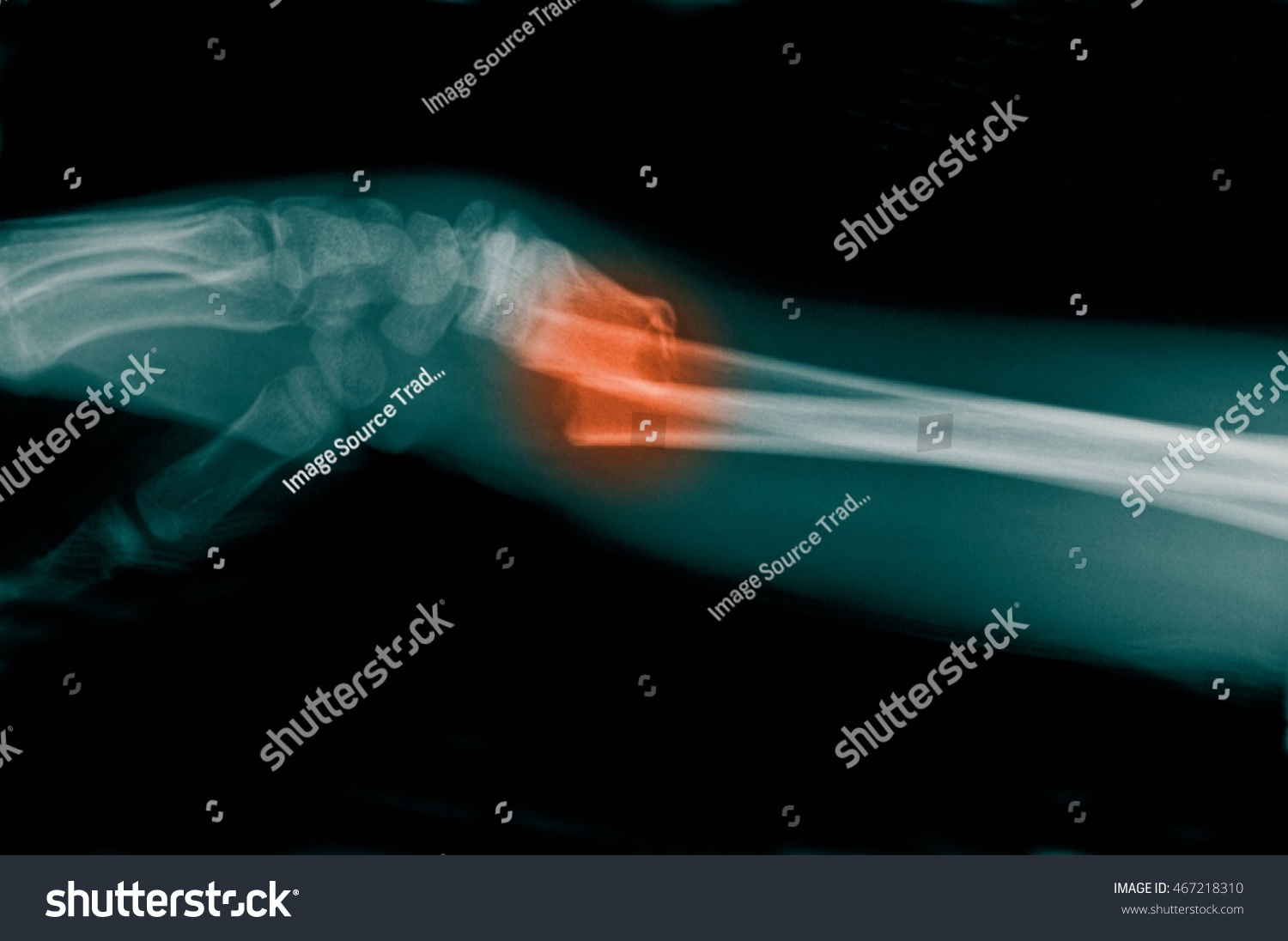 Xray Distal Forearm Fracture Stock Photo 467218310 | Shutterstock