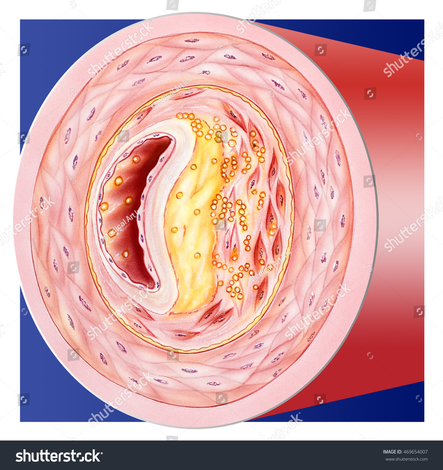 Blood Clogged Vessel Cutaway Cross Section Stock Illustration 469654007 ...