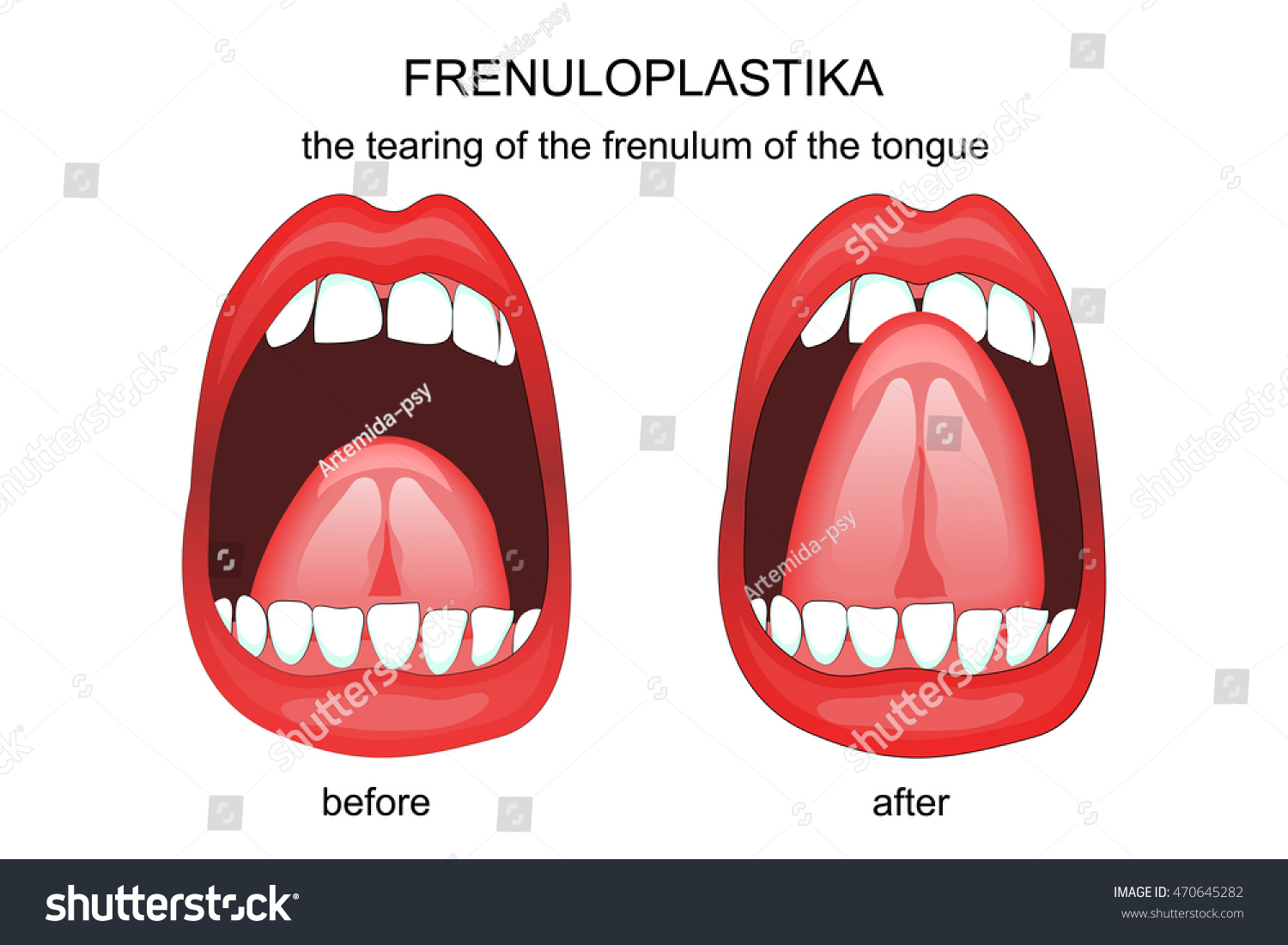 Vektor Stok Illustration Dissection Frenulum Tongue Frenuloplastika