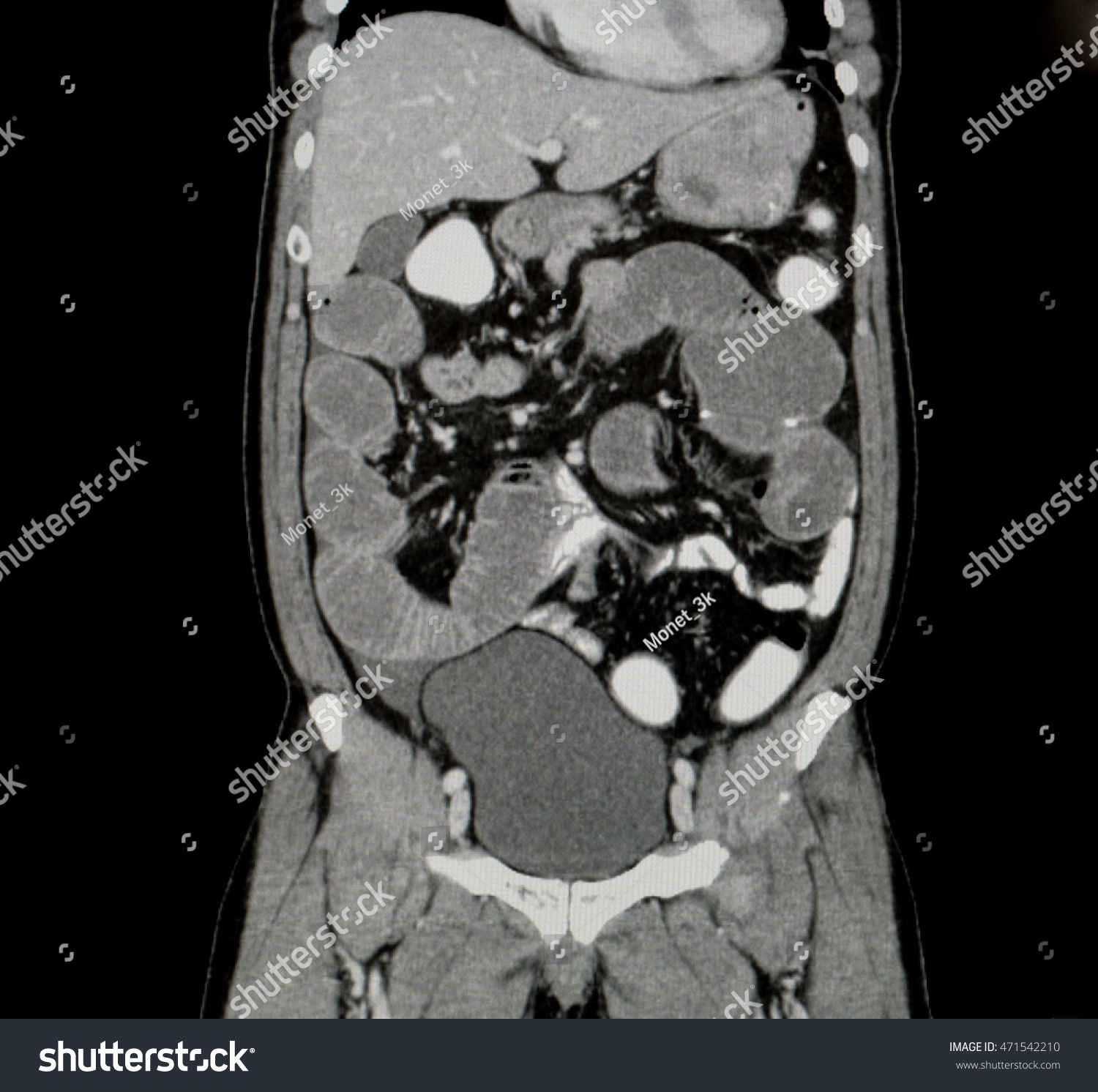 Ct Whole Abdomen Front View Stock Photo 471542210 | Shutterstock