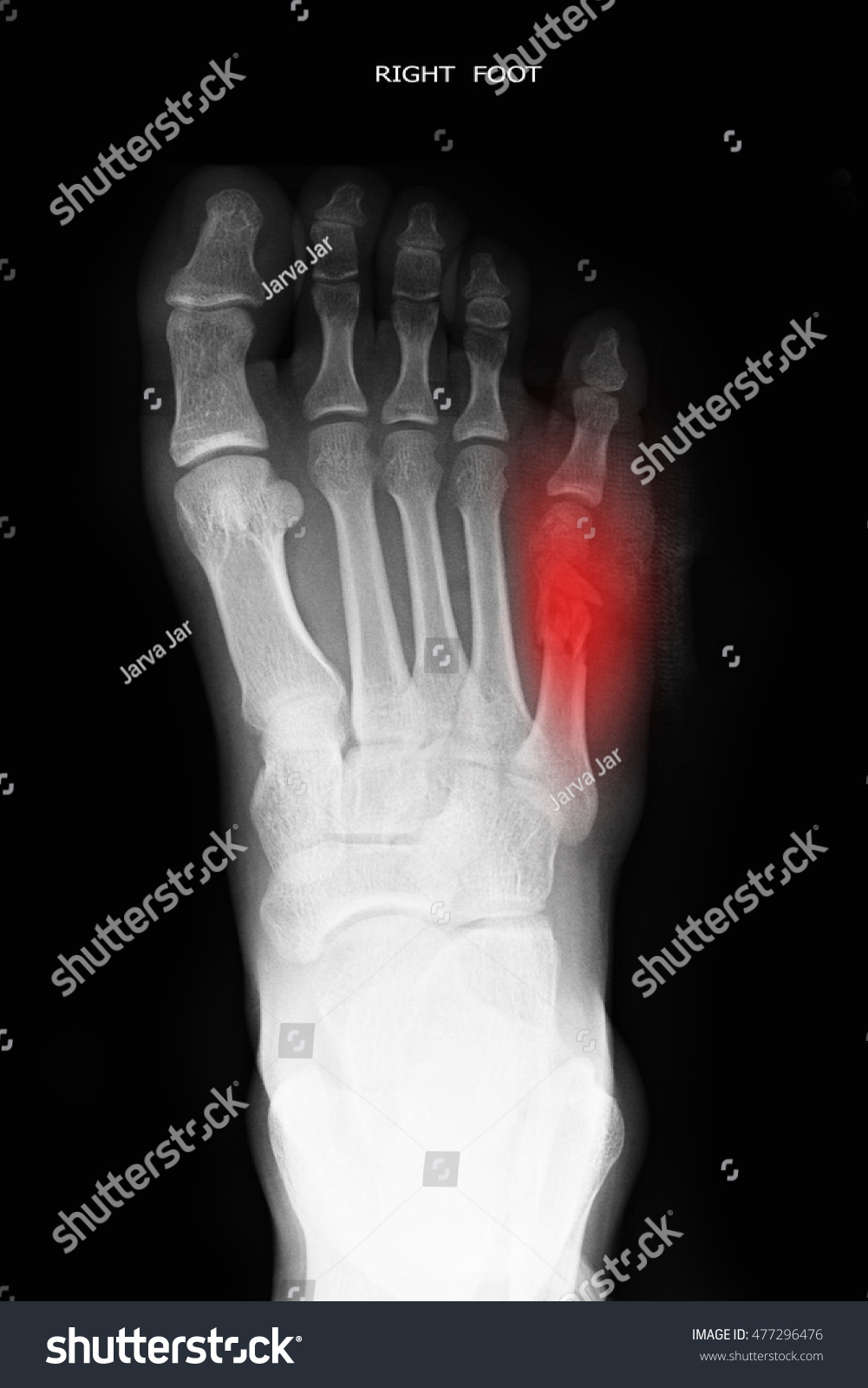 Fracture 5 Th Toe Right Stock Photo 477296476 | Shutterstock