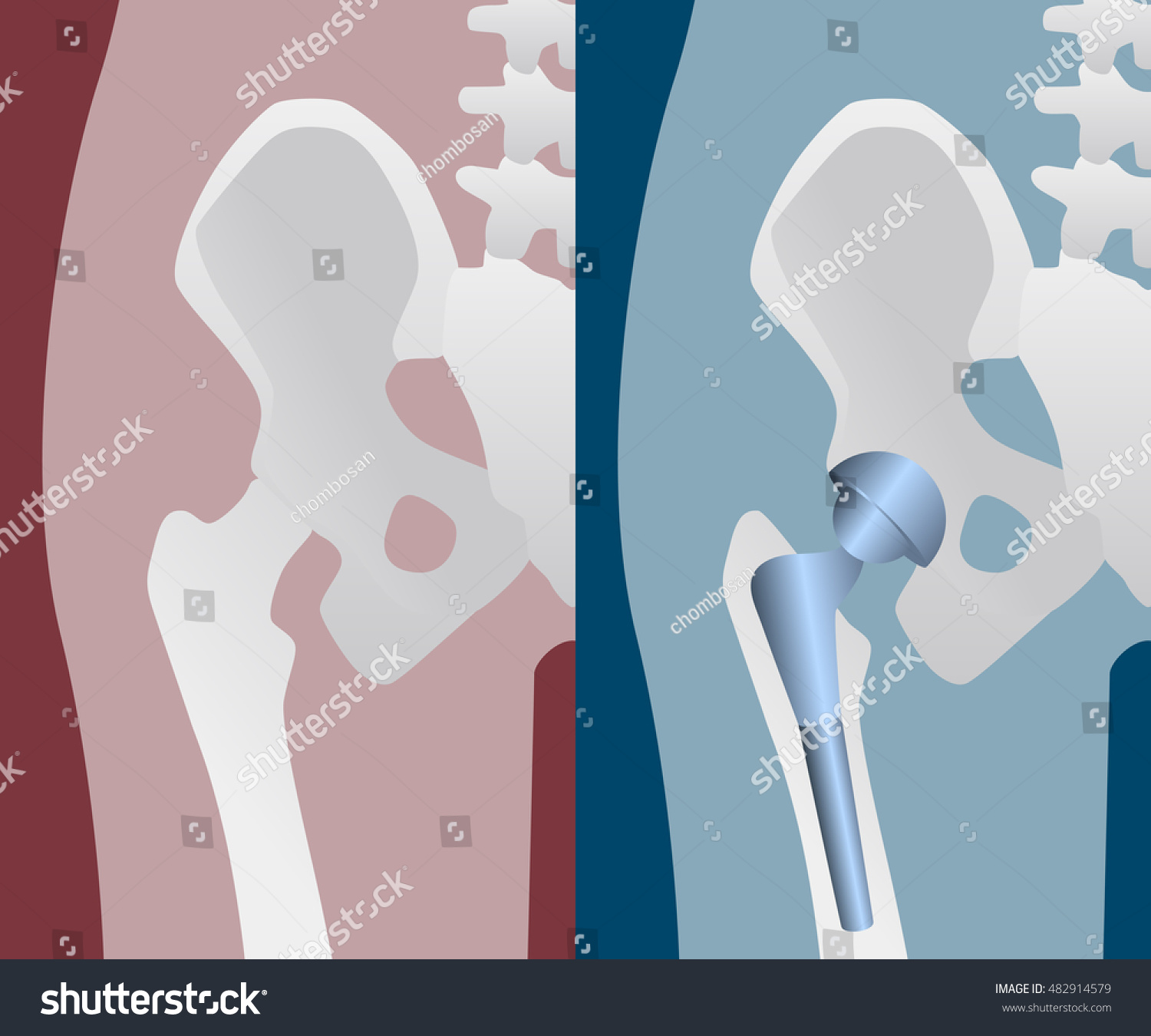 Human Artificial Hip Joint Artificial Hip Stock Vector (Royalty Free ...