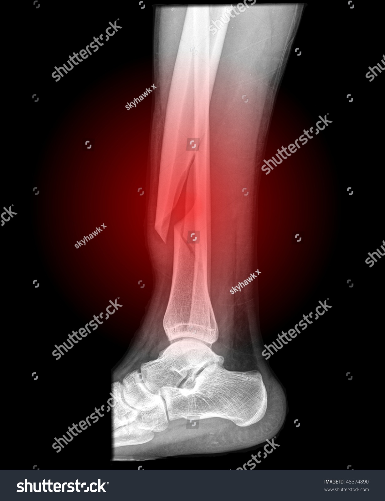 Broken Lower Leg Side View Red Stock Photo 48374890 | Shutterstock