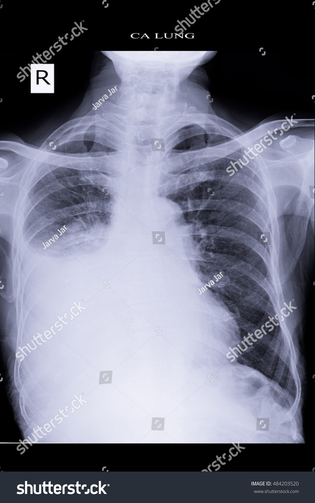 Chest Xray Show Lung Cancer Infiltration Stock Photo 484203520 ...