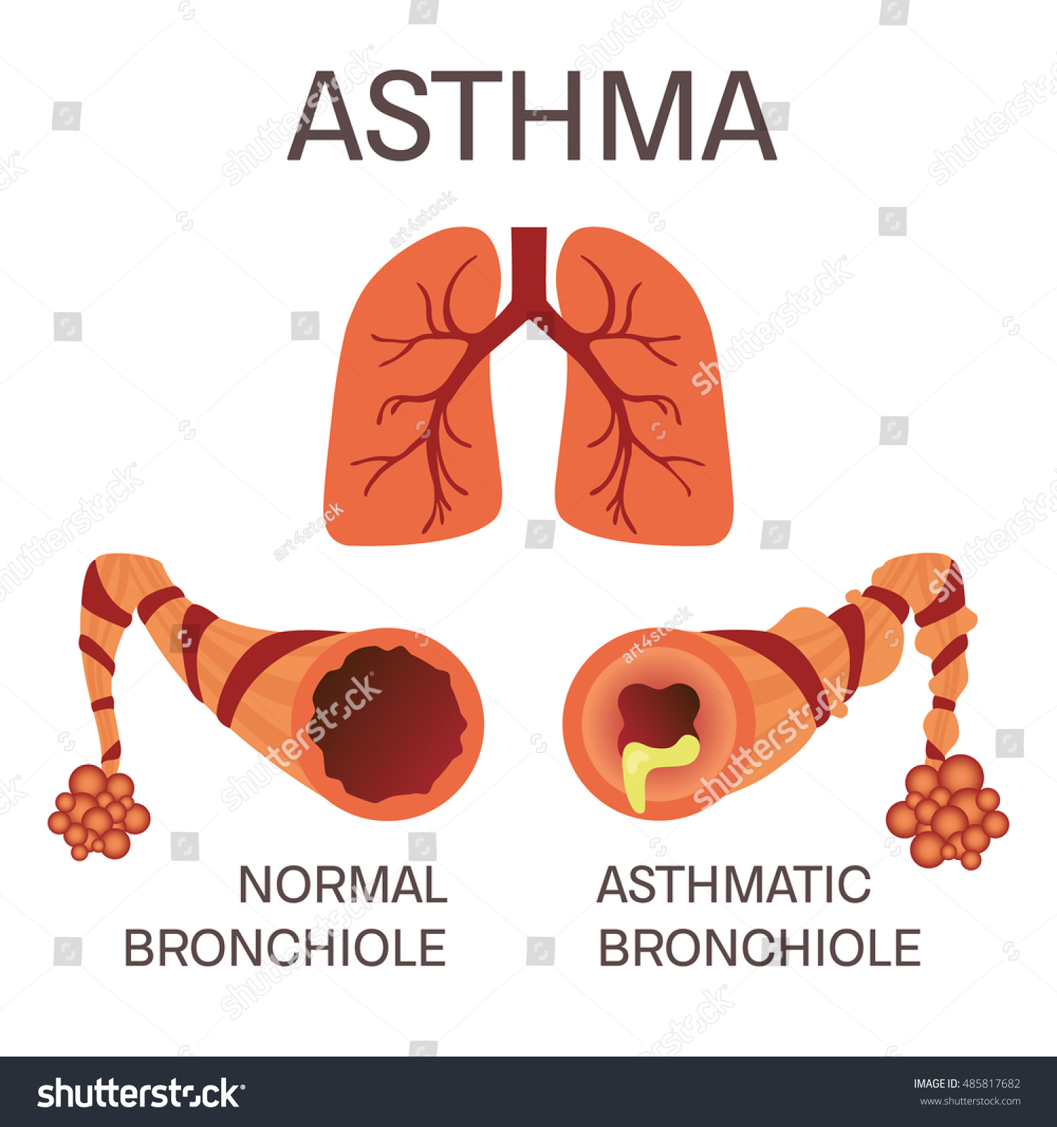 Normal Asthmatic Bronchioles On White Background Stock Vector (Royalty ...