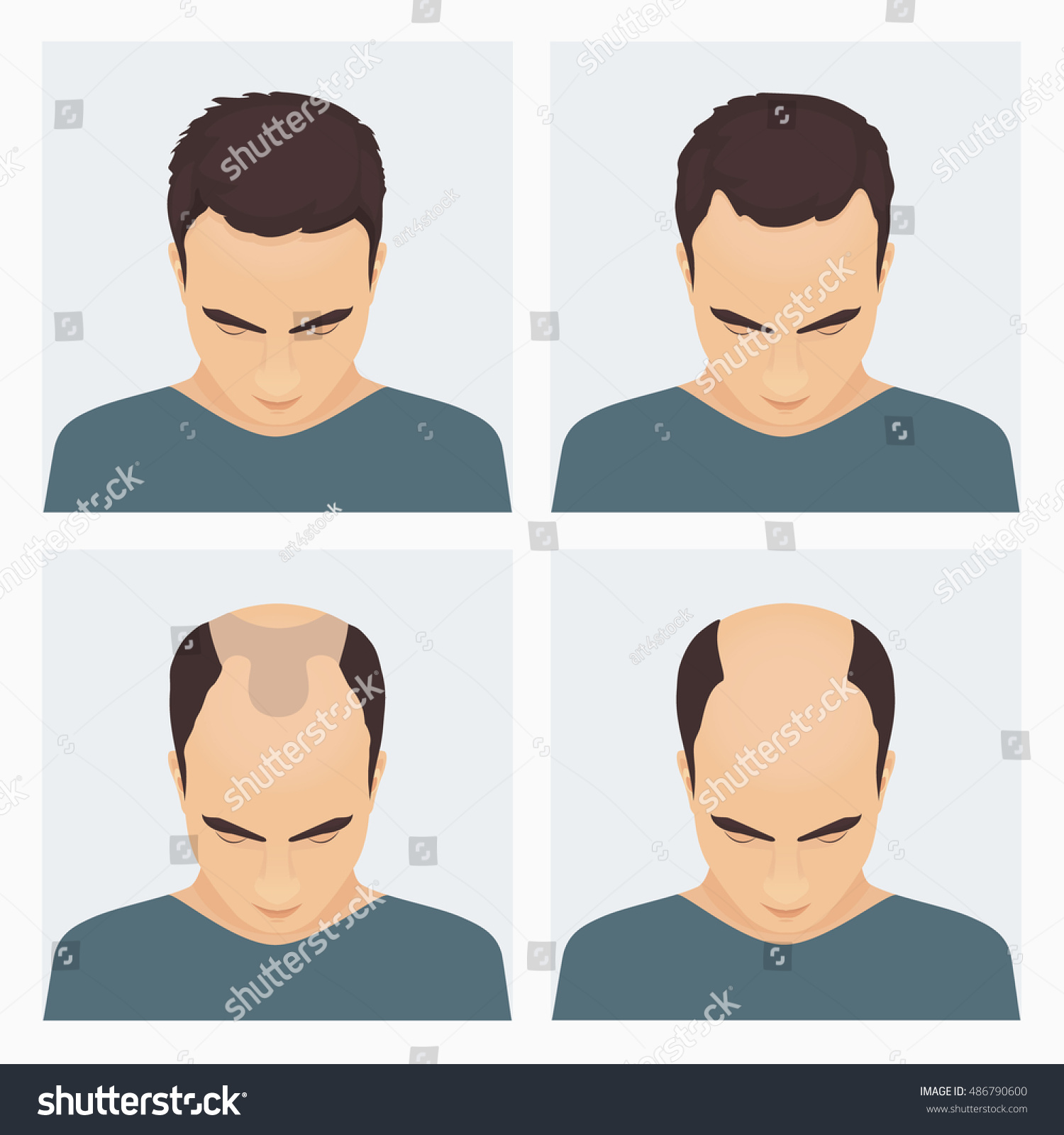 Men Alopecia Stages Set Male Pattern Stock Illustration 486790600 ...